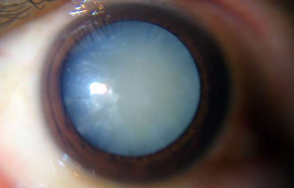 фото катаракты глаза